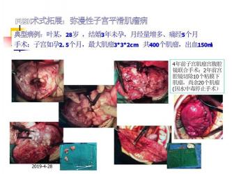 子宫腺肌症的治疗：药物与手术方案详解，守护女性健康新选择