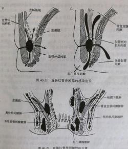 肛瘘的病因揭秘：从肛周脓肿到直肠压力，你了解多少？