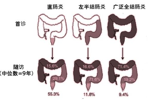 结肠炎：结肠症状识别与多元化治疗方案