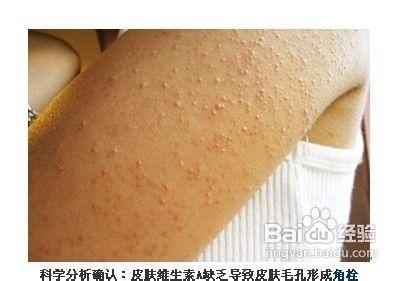 夏天身上痒怎么办？原因分析与缓解方法全解析