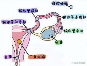 宫外孕症状早期识别：守护母婴安全的关键一步