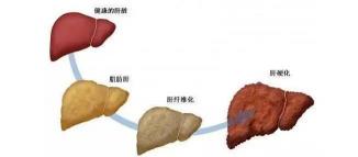 脂肪肝形成的最主要原因是：饮食失衡与代谢障碍