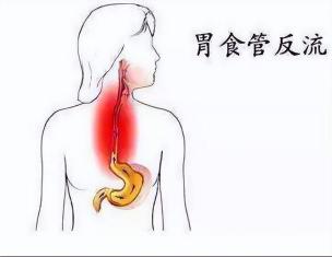 返流性食管炎：认识症状，探索治疗方法，重拾健康生活