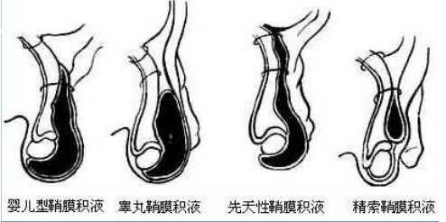 小儿鞘膜积液：全面了解治疗方法与护理