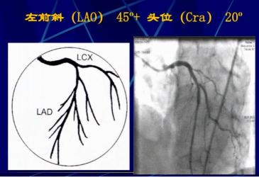 冠状动脉造影检查：诊断冠心病的科学之选