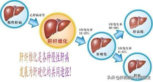 肝硬化患者的饮食指南：科学搭配，助力康复