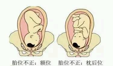 胎位ROA：正常胎位与应对胎位不正的方法