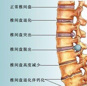 椎间盘突出症：了解症状、原因及预防方法