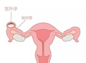 盆腔炎的自我疗法：缓解症状、预防复发的实用指南