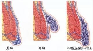 肛门疾病不容忽视，及时就医是关键！