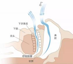 打呼噜怎么才能治好？从药物、手术到生活习惯的全方位治疗方法解析