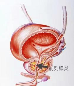 慢性细菌性前列腺炎：症状、病因与中西医治疗解析