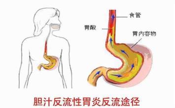 胆汁返流性胃炎的症状及应对策略：保护胃部健康，缓解不适