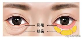 去眼袋的最好方法大公开：告别熊猫眼，重拾明亮双眸