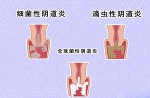 如何彻底治愈霉菌性阴道炎：规范治疗与预防措施全面解析