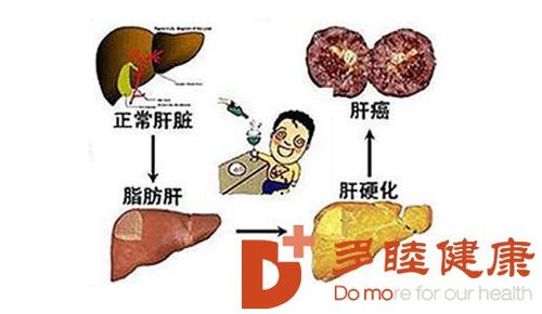 肝硬化治疗全攻略：方法、管理与预防