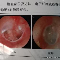 耳鼓膜穿孔：原因、症状与治疗全面解析