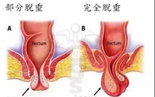 痔疮的原因：职业、局部刺激、静脉压增高及其他因素