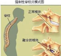 强直性脊柱炎的病因：遗传、感染与免疫因素共同作用