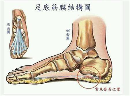 脚跟痛：原因、影响与日常护理