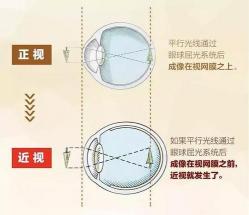 初中生近视眼的快速恢复方法：转眼法、洗眼球法、黑暗训练法与食疗法